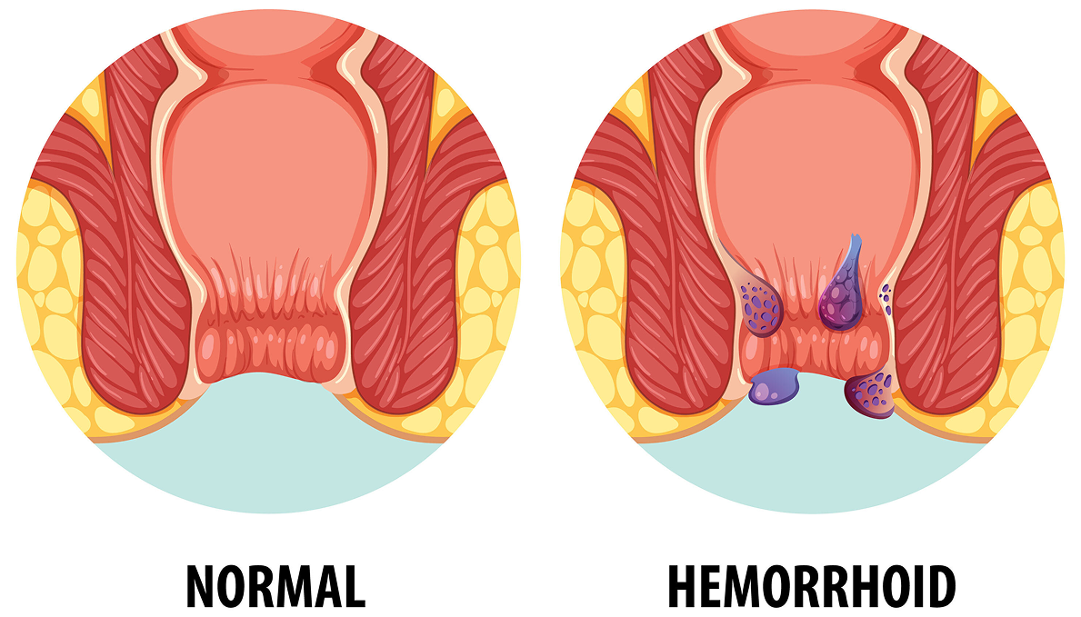 Piles Information Diagram